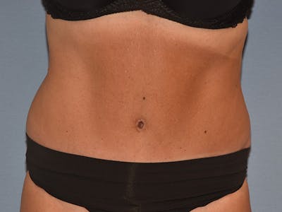 Tummy Tuck Before & After Gallery - Patient 206873 - Image 2