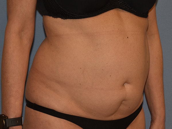 Tummy Tuck Before & After Gallery - Patient 206873 - Image 3
