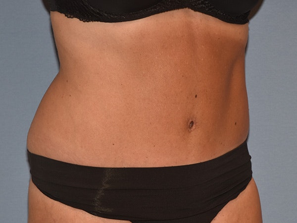 Tummy Tuck Before & After Gallery - Patient 206873 - Image 4