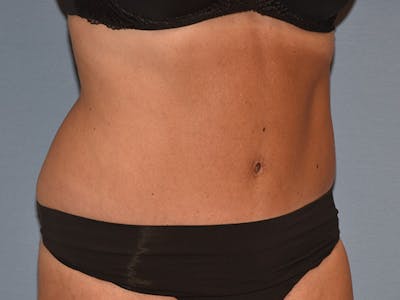Tummy Tuck Before & After Gallery - Patient 206873 - Image 4