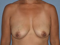 Breast Augmentation with Lift Before & After Gallery - Patient 296440 - Image 1