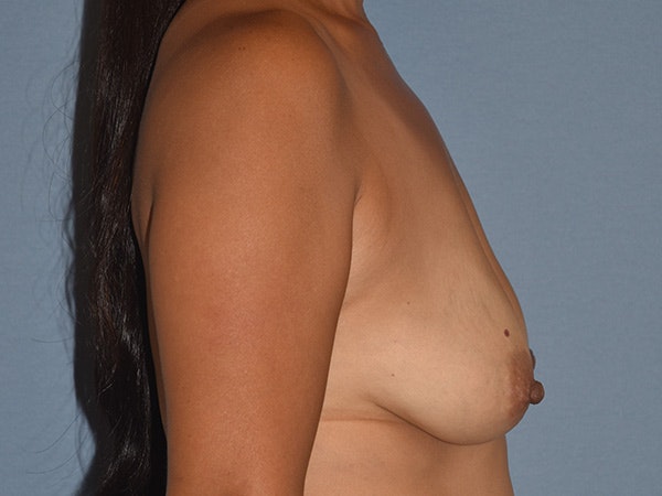 Breast Augmentation with Lift Before & After Gallery - Patient 296440 - Image 5