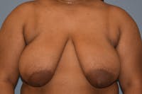 Breast Reduction Before & After Gallery - Patient 363121 - Image 1