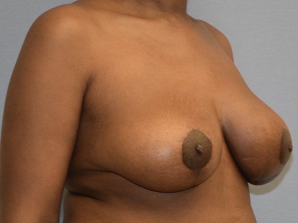 Breast Implant Removal Before & After Gallery - Patient 209563 - Image 4