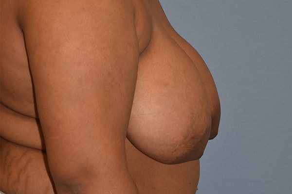 Breast Reduction Before & After Gallery - Patient 363121 - Image 5