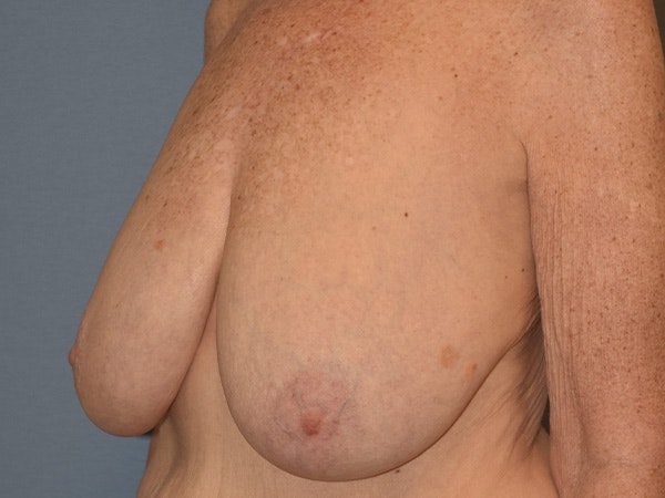 Breast Reduction Before & After Gallery - Patient 374720 - Image 3