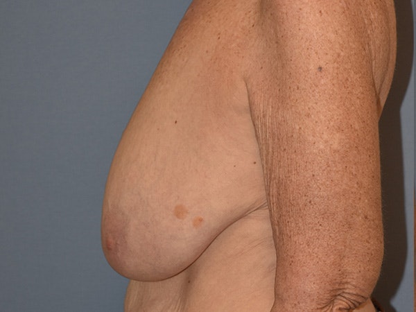 Breast Reduction Before & After Gallery - Patient 374720 - Image 5