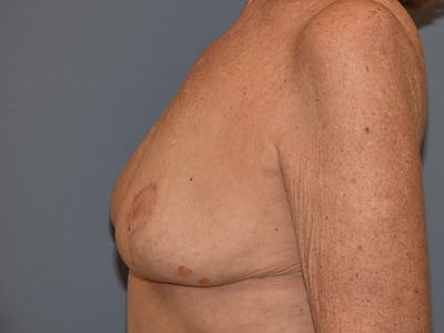 Breast Reduction Before & After Gallery - Patient 374720 - Image 6