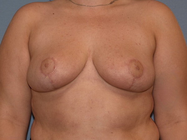 Breast Augmentation Before & After Gallery - Patient 390403 - Image 2