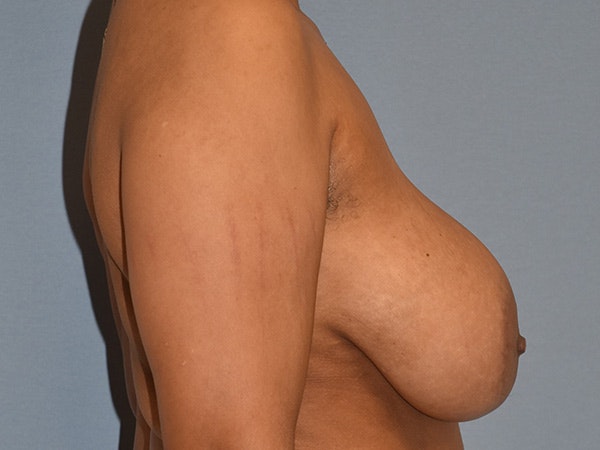 Breast Reduction Before & After Gallery - Patient 405155 - Image 5