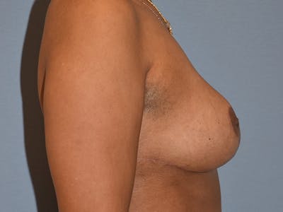 Breast Reduction Before & After Gallery - Patient 405155 - Image 6