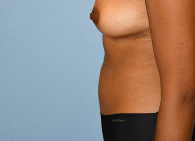Tummy Tuck Before & After Gallery - Patient 874260 - Image 10