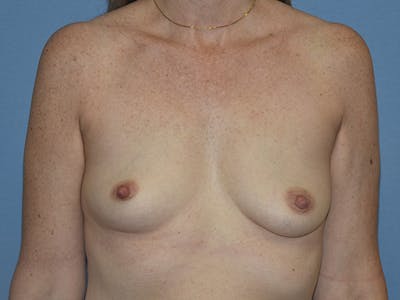 Breast Augmentation Before & After Gallery - Patient 390403 - Image 1