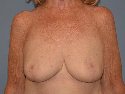 Breast Reduction Before & After Gallery - Patient 374720 - Image 2