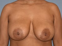 Breast Reduction Before & After Gallery - Patient 405155 - Image 1