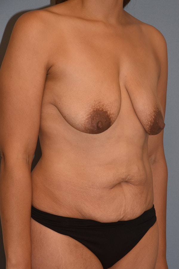 Mommy Makeover Before & After Gallery - Patient 324022 - Image 3