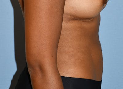 Tummy Tuck Before & After Gallery - Patient 874260 - Image 6