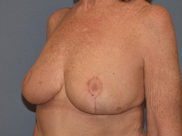 Breast Reduction Before & After Gallery - Patient 374720 - Image 4