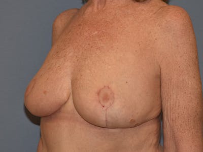 Breast Reduction Before & After Gallery - Patient 374720 - Image 4