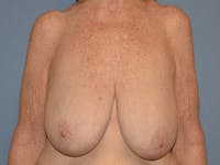 Breast Reduction Before & After Gallery - Patient 374720 - Image 1