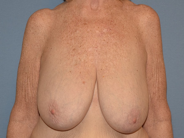 Breast Reduction Before & After Gallery - Patient 374720 - Image 1