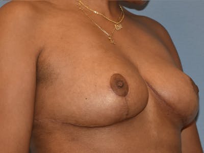Breast Reduction Before & After Gallery - Patient 405155 - Image 4