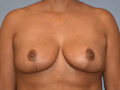 Breast Reduction Before & After Gallery - Patient 405155 - Image 2