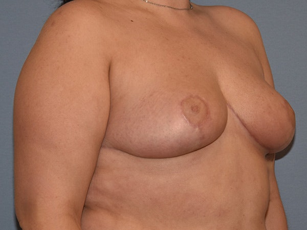 Breast Reduction Before & After Gallery - Patient 396740 - Image 4