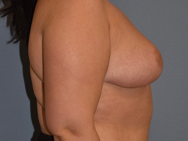 Breast Reduction Before & After Gallery - Patient 396740 - Image 6