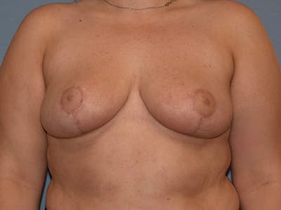 Breast Reduction Before & After Gallery - Patient 396740 - Image 2