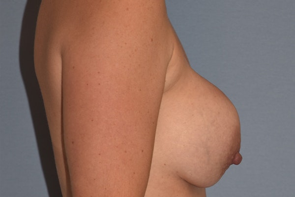 Breast Revision Before & After Gallery - Patient 194036 - Image 5