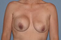 Breast Revision Before & After Gallery - Patient 194036 - Image 1