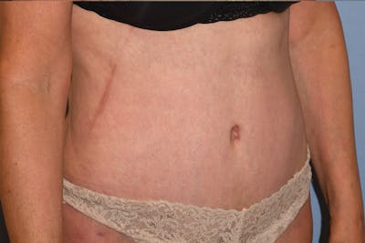 Tummy Tuck Before & After Gallery - Patient 702777 - Image 4