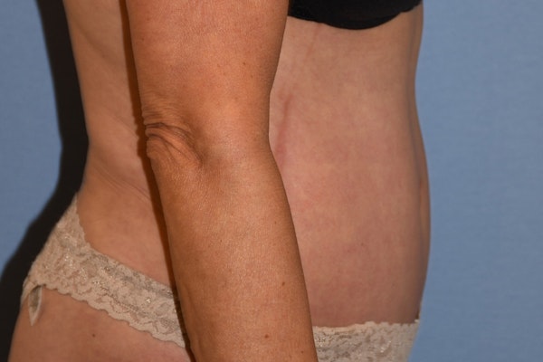 Tummy Tuck Before & After Gallery - Patient 702777 - Image 6