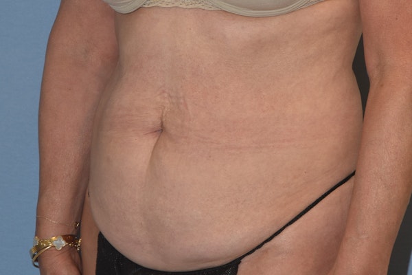 Tummy Tuck Before & After Gallery - Patient 702777 - Image 7