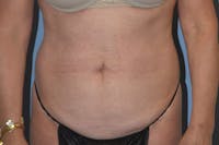 Tummy Tuck Before & After Gallery - Patient 702777 - Image 1