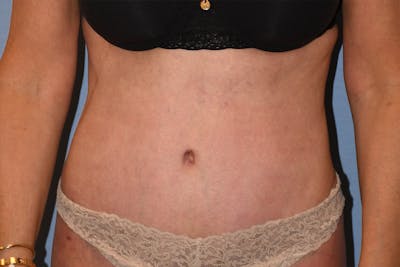 Tummy Tuck Before & After Gallery - Patient 702777 - Image 2