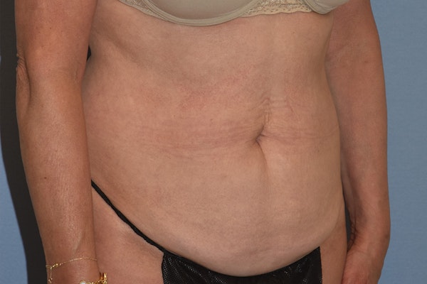 Tummy Tuck Before & After Gallery - Patient 702777 - Image 3