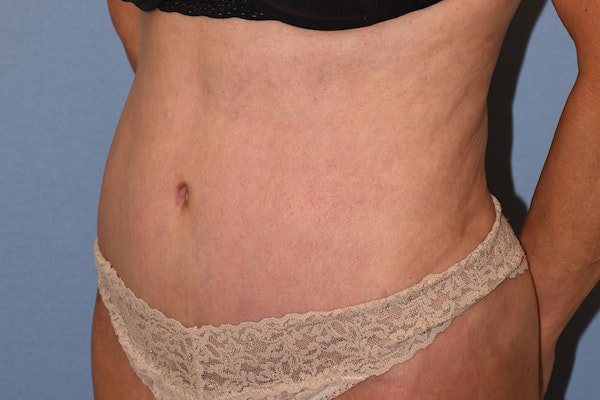Tummy Tuck Before & After Gallery - Patient 702777 - Image 8