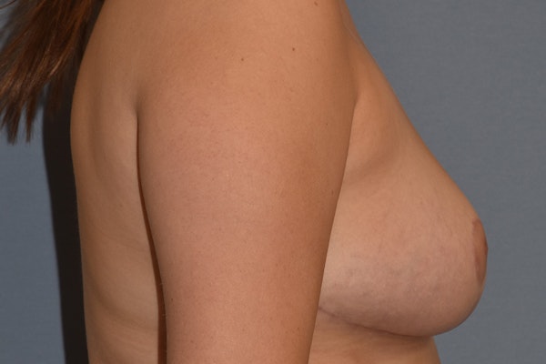 Breast Reduction Before & After Gallery - Patient 663954 - Image 6