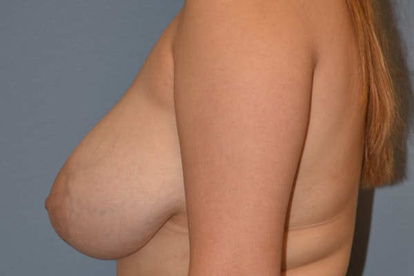 Breast Reduction Before & After Gallery - Patient 663954 - Image 9