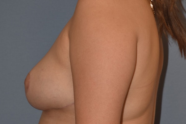 Breast Reduction Before & After Gallery - Patient 663954 - Image 10