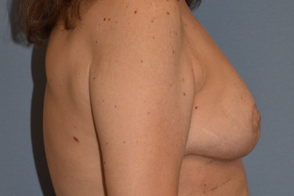 Breast Reduction Before & After Gallery - Patient 160195 - Image 6