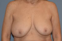 Breast Reduction Before & After Gallery - Patient 160195 - Image 1