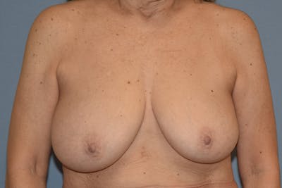 Breast Reduction Before & After Gallery - Patient 160195 - Image 1