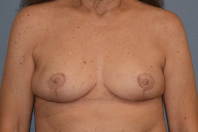 Breast Reduction Before & After Gallery - Patient 160195 - Image 2