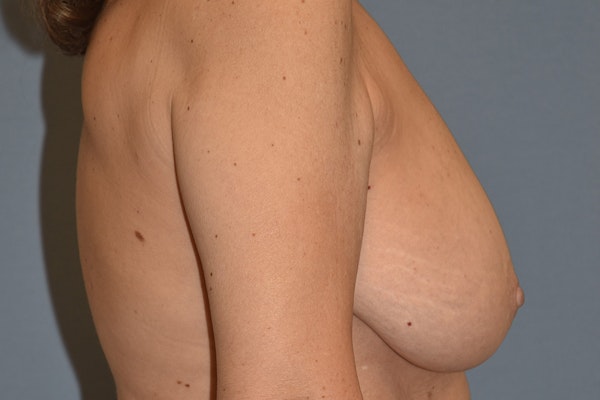 Breast Reduction Before & After Gallery - Patient 160195 - Image 5