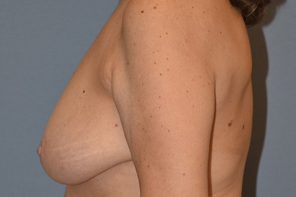 Breast Reduction Before & After Gallery - Patient 160195 - Image 9
