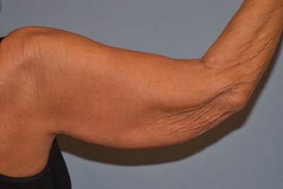 Arm Lift Before & After Gallery - Patient 238284 - Image 1
