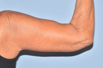 Arm Lift Before & After Gallery - Patient 238284 - Image 2